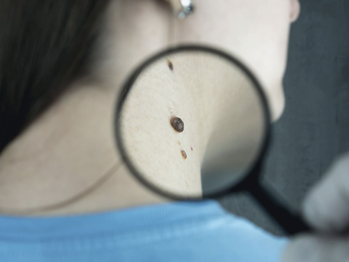 A clinician holds a magnifying glass over a mole on a patient’s neck.
