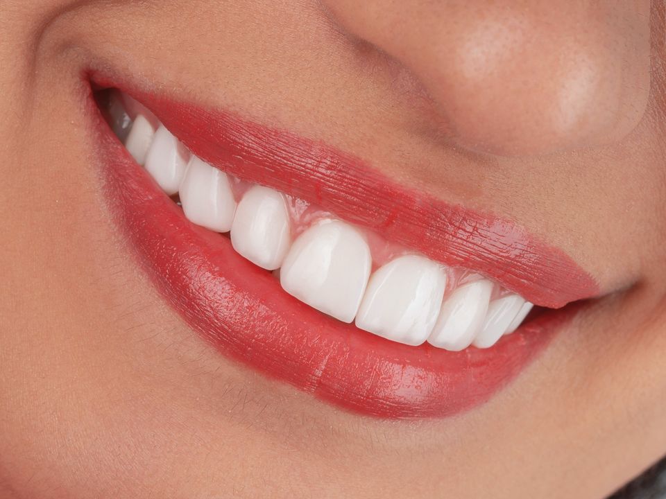 Simulated after: brighter, even porcelain veneers